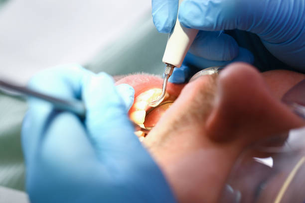 Best Emergency Root Canal Treatment in Elkhorn, WI