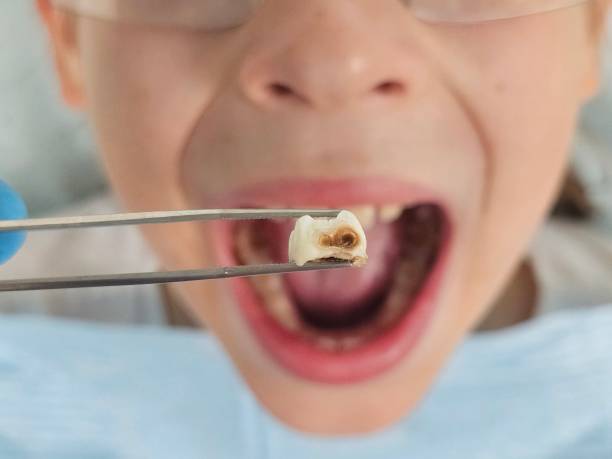 Best Urgent Care for Lost Fillings or Crowns in Elkhorn, WI